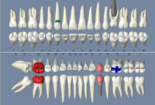 Open Dental Graphical Tooth Chart