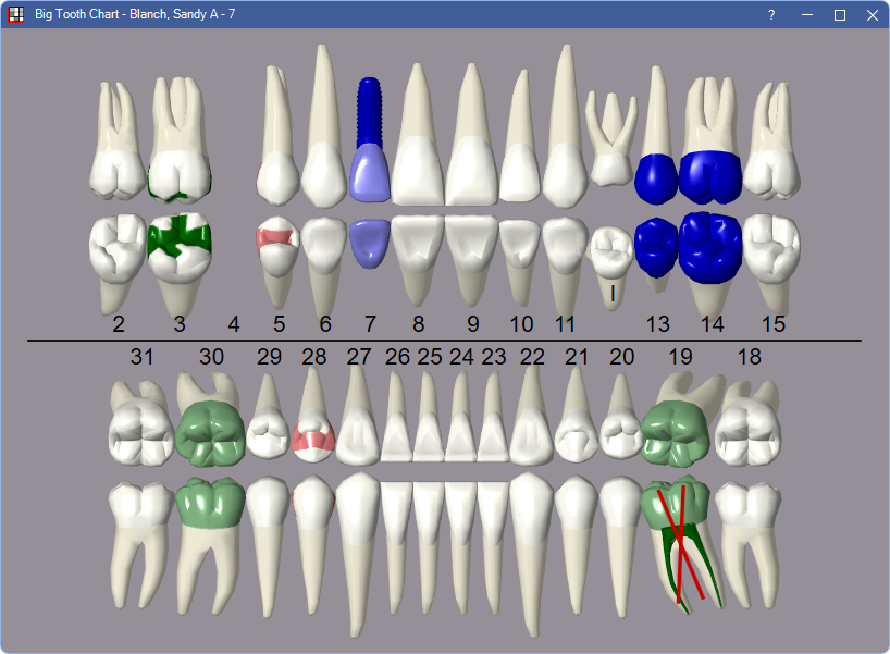 Open Dental Software Big Graphical Tooth Chart